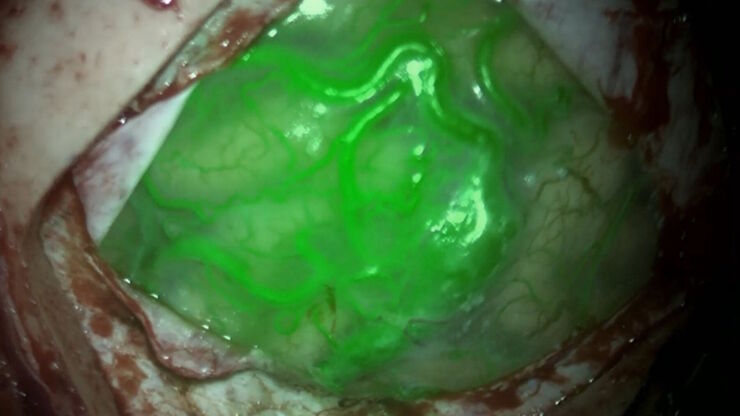 Use of GLOW800 Augmented Reality during AVM surgery. Image courtesy of Prof. Philippe Bijlenga.